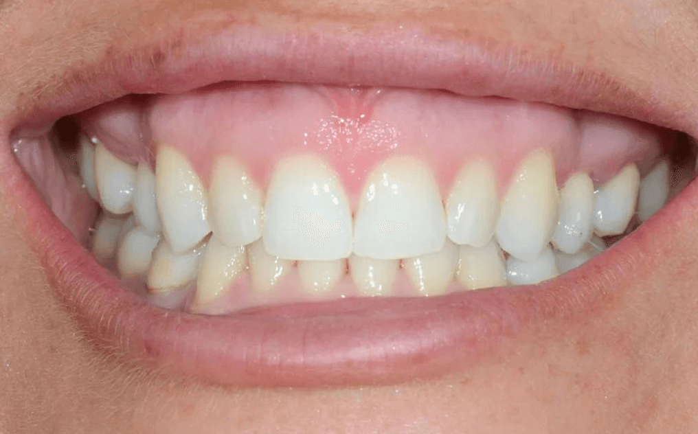 Sarah's smile after treatment with STRAIGHTS