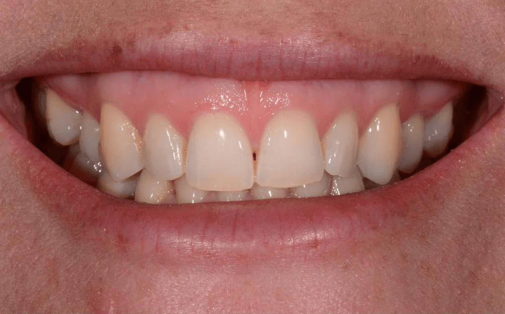 Sarah's smile before treatment with STRAIGHTS